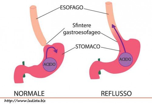 la malattia da reflusso gastroesofageo