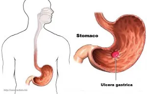 ulcera peptica