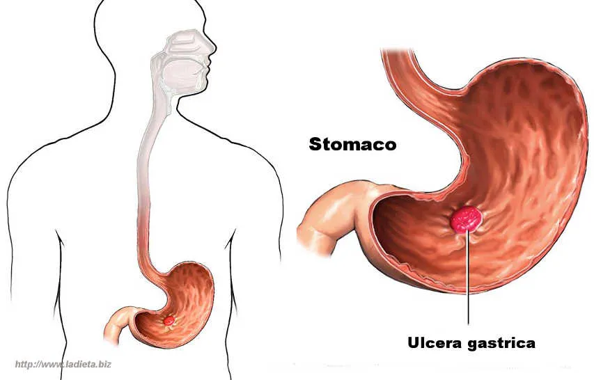 ulcera peptica
