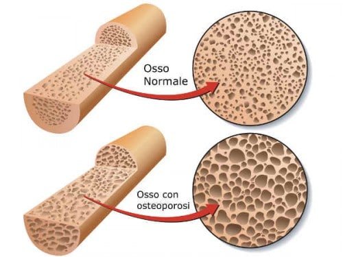 osteoporosi
