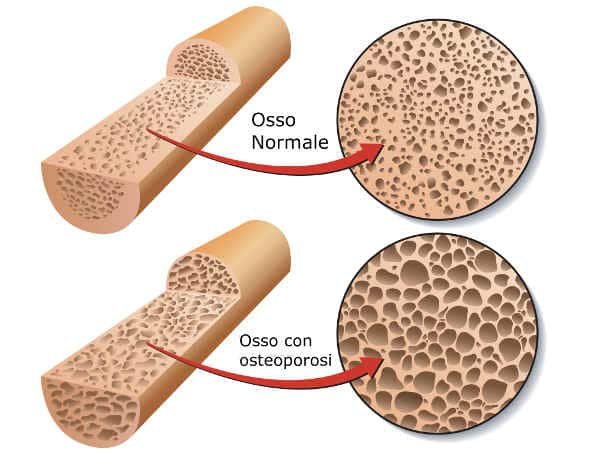 osteoporosi