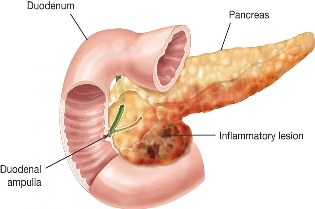pancreatite - infiammazione del pancreas