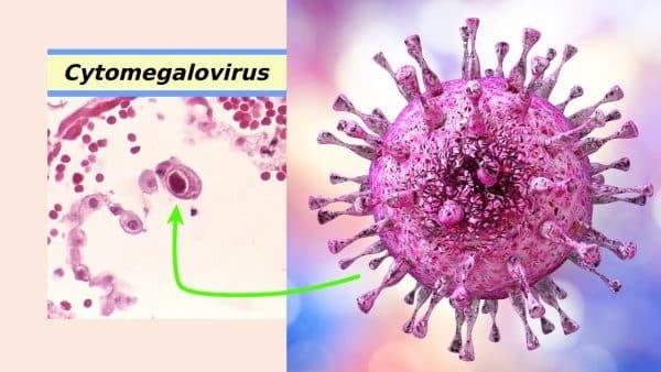 citomegalovirus come si prende