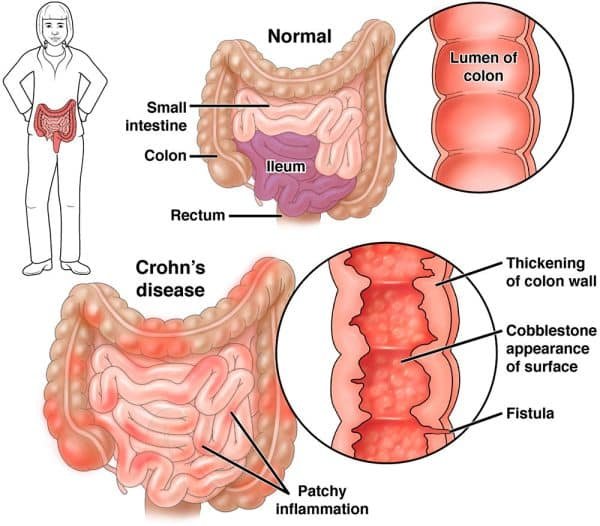 Morbo di Crohn sintomi