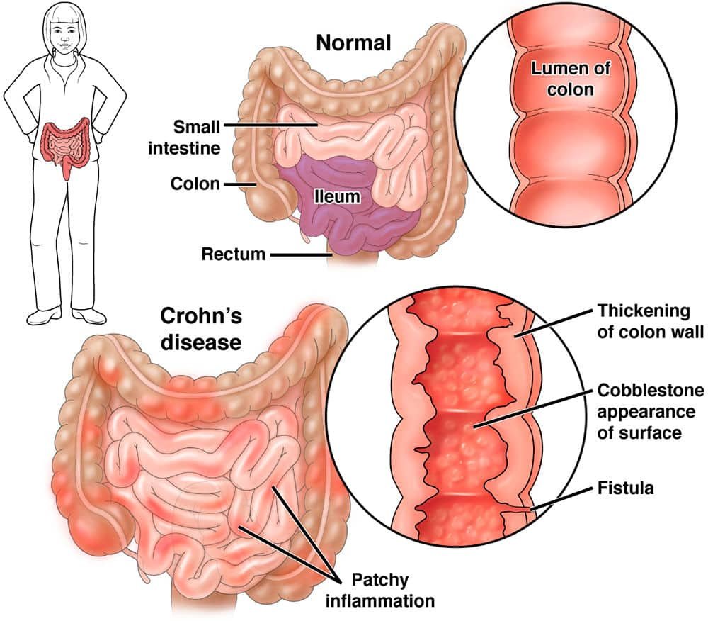 Morbo di Crohn sintomi